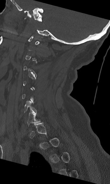 File:Cervical spine fracture - chalk stick (Radiopaedia 39116-41323 Sagittal bone window 18).png