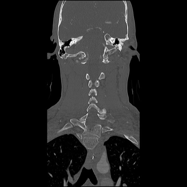 File:Cervical spine fractures with vertebral artery dissection (Radiopaedia 32135-33078 Coronal bone window 18).jpg