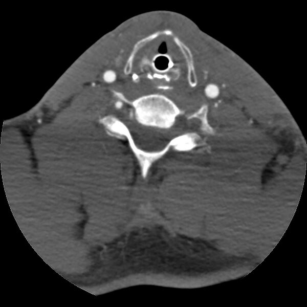 File:Cervical spine fractures with vertebral artery dissection (Radiopaedia 32135-33078 D 33).jpg