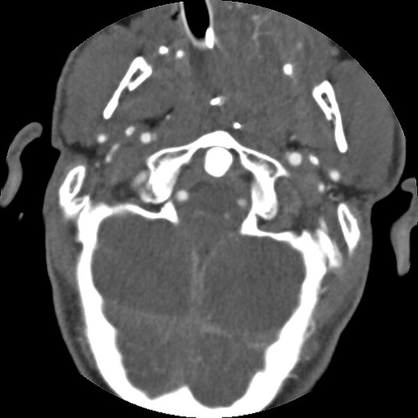 File:Cervical spine fractures with vertebral artery dissection (Radiopaedia 32135-33078 D 69).jpg