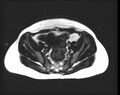 Cesarean section scar endometrioma (Radiopaedia 56569-63297 Axial T1 12).jpg
