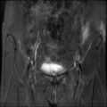 Cesarian section scar endometriosis (Radiopaedia 66520-75799 Coronal STIR 7).jpg
