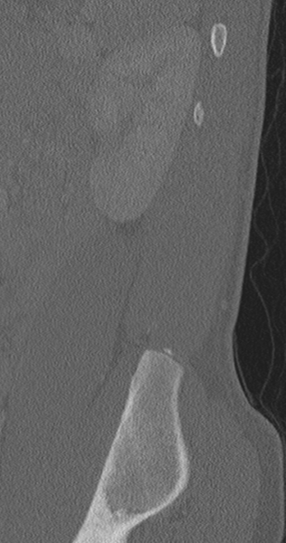 File:Chance fracture (Radiopaedia 40360-42912 Sagittal bone window 13).png