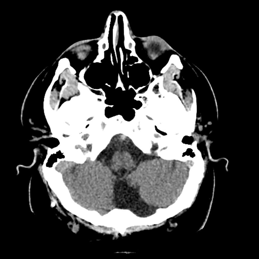 Chiasmatic-hypothalamic juvenile pilocytic astrocytoma (Radiopaedia 78533-91237 Axial non-contrast 13).jpg