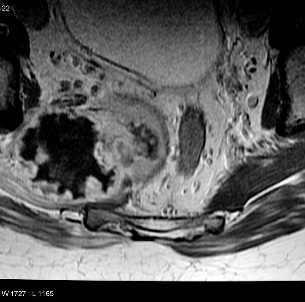 File:Chondrosarcoma - sacrum (Radiopaedia 6173-7627 Axial T1 C+ 8).jpg