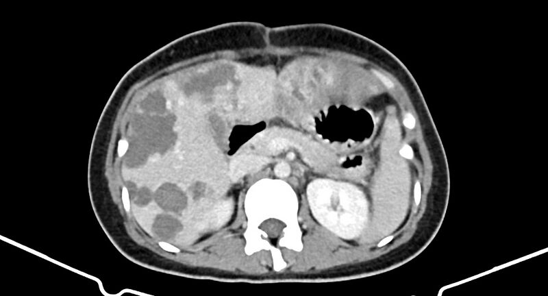 File:Choriocarcinoma liver metastases (Radiopaedia 74768-85766 A 80).jpg