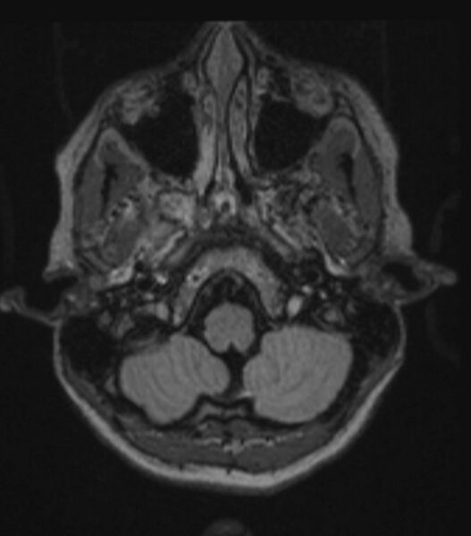 File:Choroid plexus carcinoma (Radiopaedia 91013-108553 Axial FLAIR C+ 82).jpg