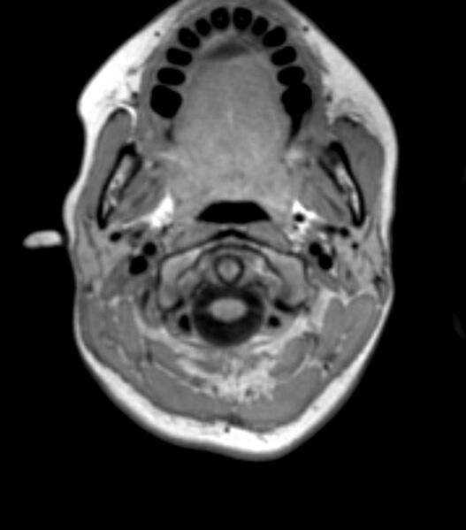 File:Choroid plexus carcinoma (Radiopaedia 91013-108553 Axial T1 18).jpg