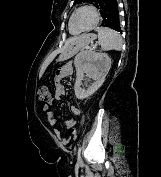 File:Chromophobe renal cell carcinoma (Radiopaedia 84239-99519 G 37).jpg
