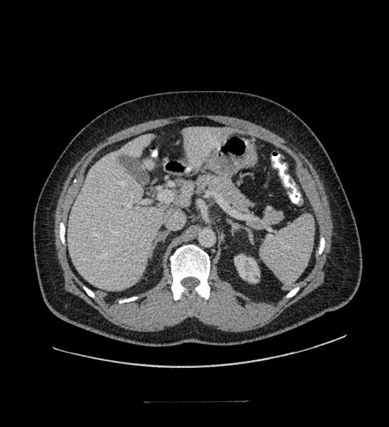 File:Chromophobe renal cell carcinoma (Radiopaedia 84337-99644 C 40).jpg