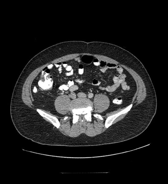 File:Chromophobe renal cell carcinoma (Radiopaedia 84337-99644 C 87).jpg