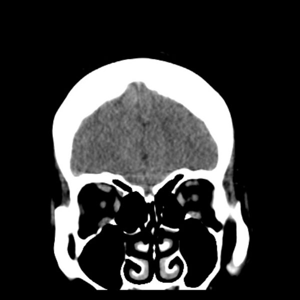 File:Chronic bilateral occipital lobe infarcts (Radiopaedia 31276-31996 Coronal non-contrast 12).jpg