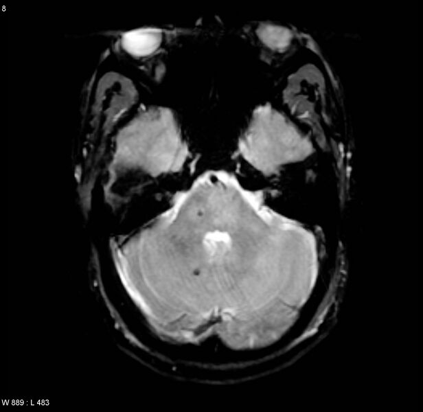 File:Chronic hypertensive encephalopathy (Radiopaedia 4564-6686 Axial Gradient Echo 3).jpg