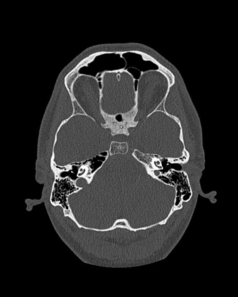 File:Chronic maxillary sinusitis caused by a foreign body (Radiopaedia 58521-65676 Axial bone window 244).jpg
