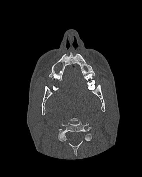 File:Chronic maxillary sinusitis caused by a foreign body (Radiopaedia 58521-65676 Axial bone window 43).jpg
