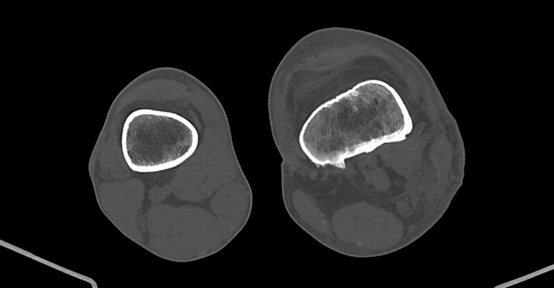 File:Chronic osteomyelitis (with sequestrum) (Radiopaedia 74813-85822 Axial non-contrast 169).jpg