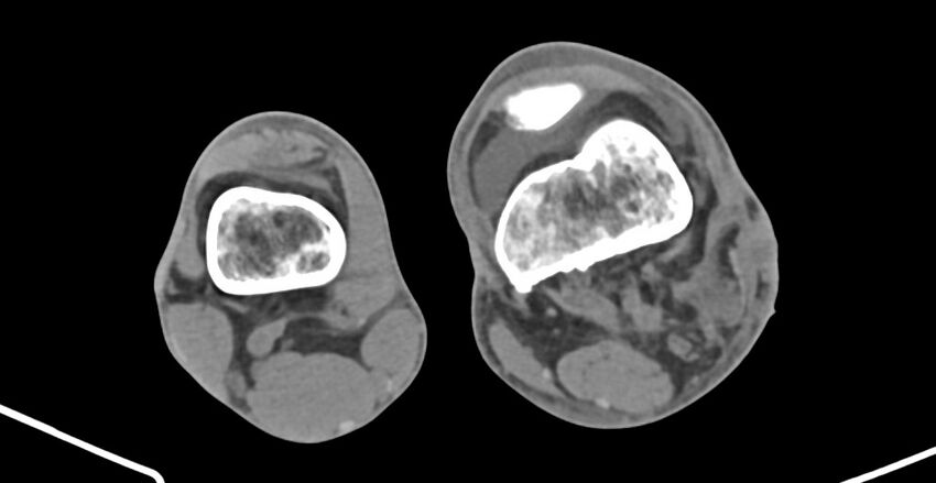 Chronic osteomyelitis (with sequestrum) (Radiopaedia 74813-85822 D 173).jpg