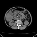 Chronic pancreatitis (Radiopaedia 23132-23172 Axial non-contrast 37).jpg