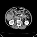 Chronic pancreatitis (Radiopaedia 23132-23172 B 28).jpg
