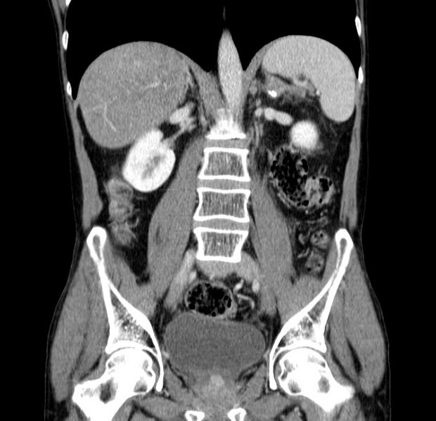 File:Chronic pancreatitis (Radiopaedia 23132-23172 C 36).jpg