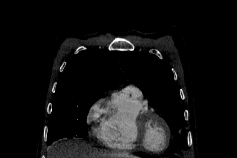 File:Chronic pulmonary embolism with bubbly consolidation (Radiopaedia 91248-108850 B 25).jpg