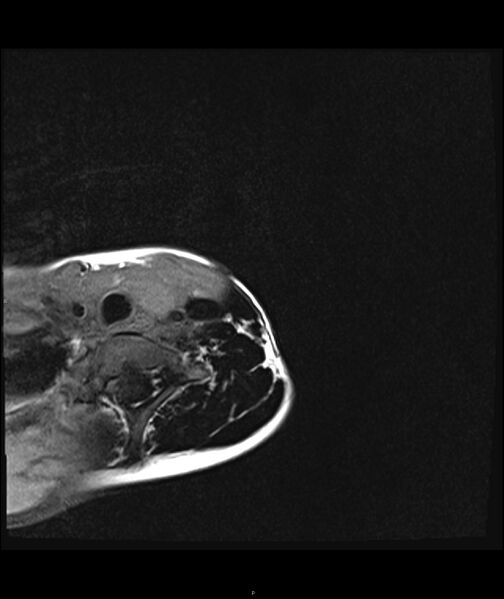 File:Chronic reactive multifocal osteomyelitis (CRMO) - clavicle (Radiopaedia 56406-63071 Axial T1 fat sat 1).jpg