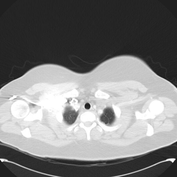 File:Chronic thromboembolic pulmonary hypertension (CTEPH) (Radiopaedia 74597-85531 Axial lung window 7).jpg