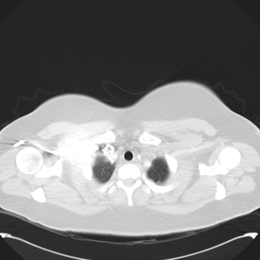 Chronic thromboembolic pulmonary hypertension (CTEPH) (Radiopaedia 74597-85531 Axial lung window 7).jpg