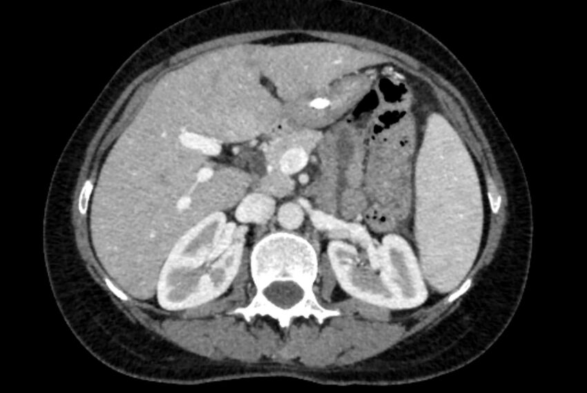 Closed loop small bowel obstruction (Radiopaedia 71211-81508 A 23).jpg