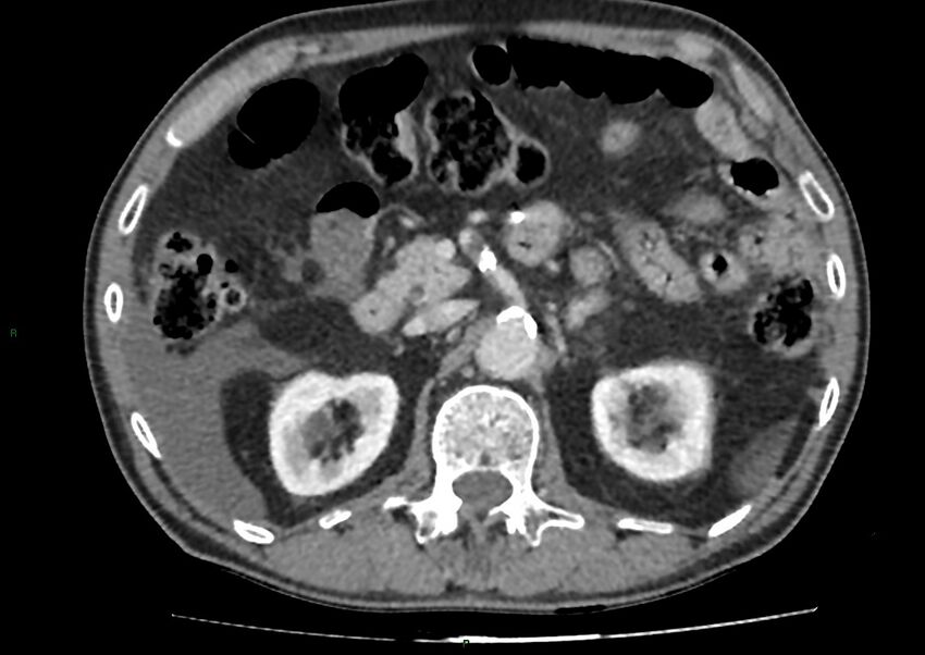 Closed loop small bowel obstruction with ischemia (Radiopaedia 84180-99456 A 41).jpg