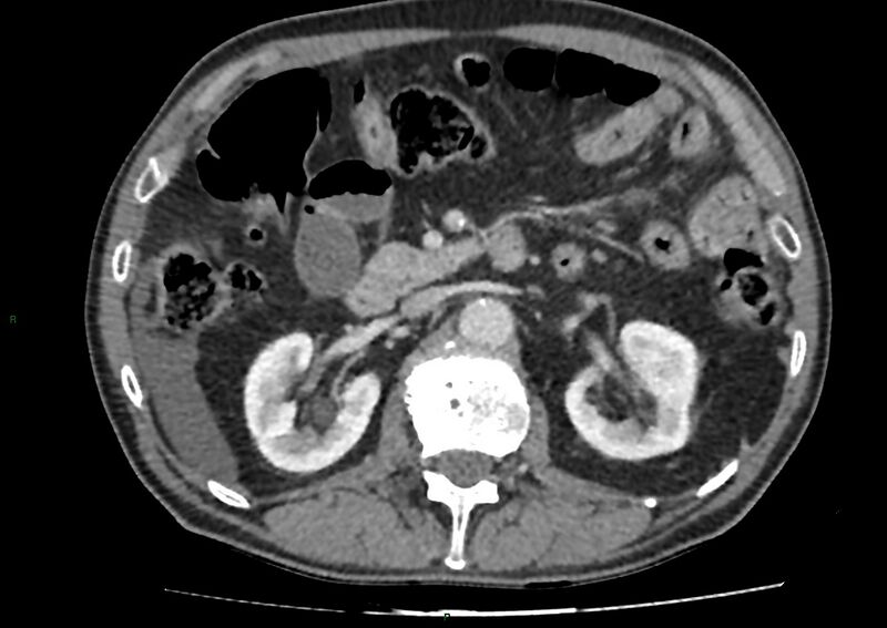File:Closed loop small bowel obstruction with ischemia (Radiopaedia 84180-99456 A 45).jpg