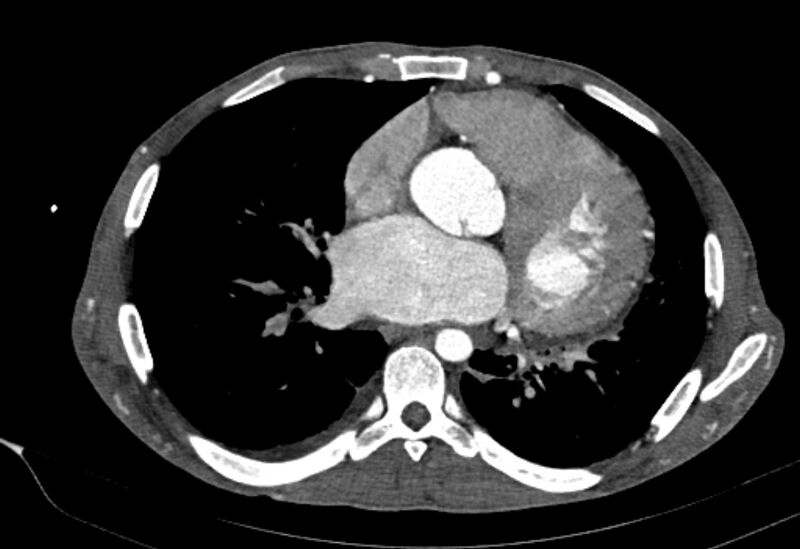 File:Coarctation of aorta with aortic valve stenosis (Radiopaedia 70463-80574 A 119).jpg