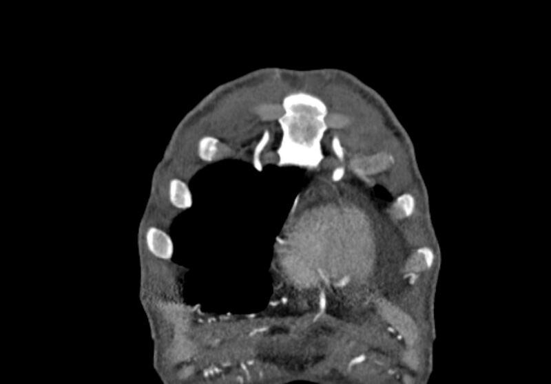 File:Coarctation of aorta with aortic valve stenosis (Radiopaedia 70463-80574 C 3).jpg
