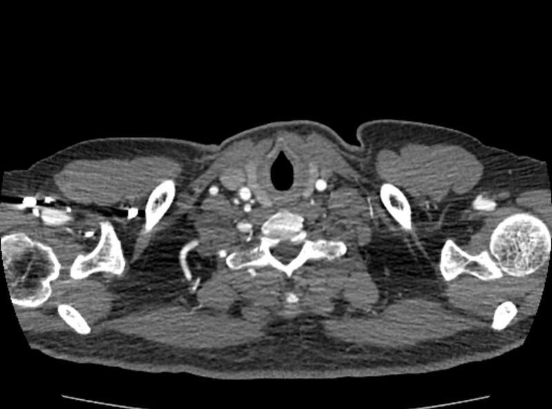 File:Coarctation of the aorta (Radiopaedia 53363-59343 A 5).jpg