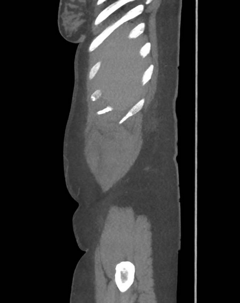 File:Colonic pseudo-obstruction (Radiopaedia 79752-92980 C 11).png