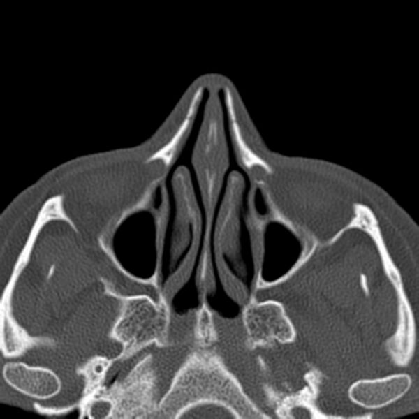 File:Nasolabial cyst (Radiopaedia 33987-35205 Axial bone window 22).jpg