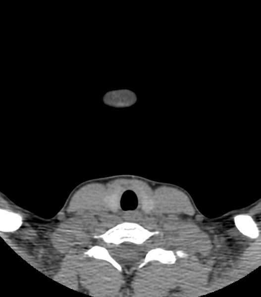 File:Nasoorbitoethmoid fracture (Radiopaedia 90044-107205 Axial non-contrast 3).jpg