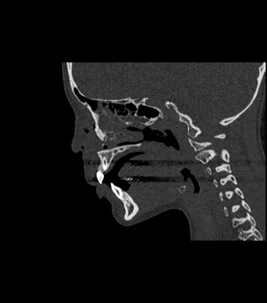 File:Nasoorbitoethmoid fracture (Radiopaedia 90044-107205 Sagittal bone window 84).jpg