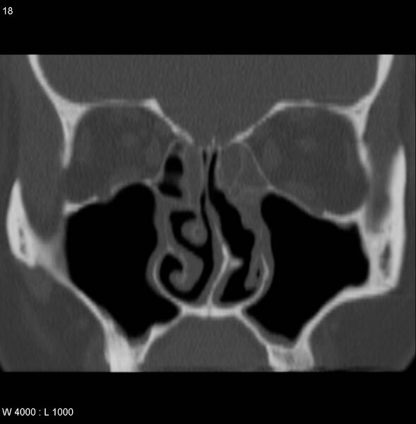 File:Nasopharyngeal carcinoma (recurrent) (Radiopaedia 5061-6903 Coronal bone window 1).jpg