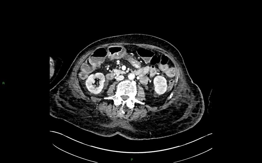 Neo-terminal ileal stricture (Crohn disease) (Radiopaedia 33790-34948 A 203).jpg