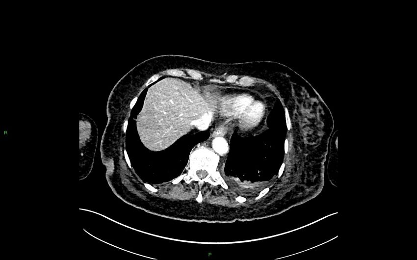 Neo-terminal ileal stricture (Crohn disease) (Radiopaedia 33790-34948 A 37).jpg