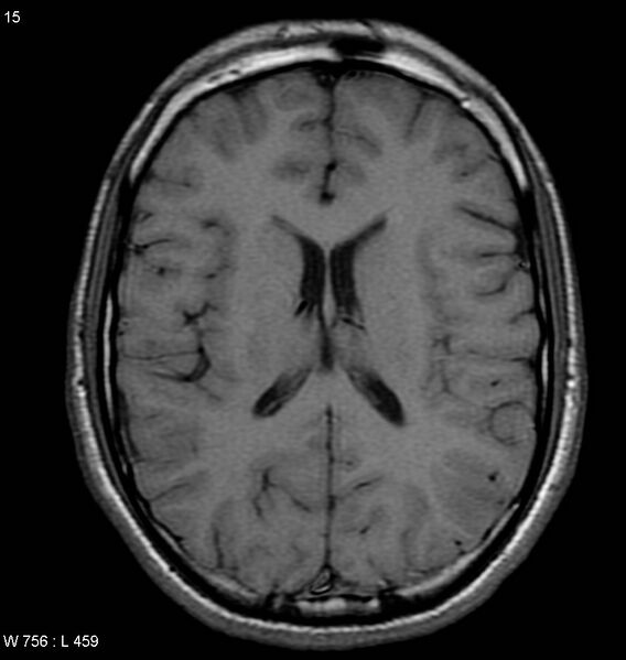 File:Neurocysticercosis (Radiopaedia 4767-6773 Axial T1 1).jpg