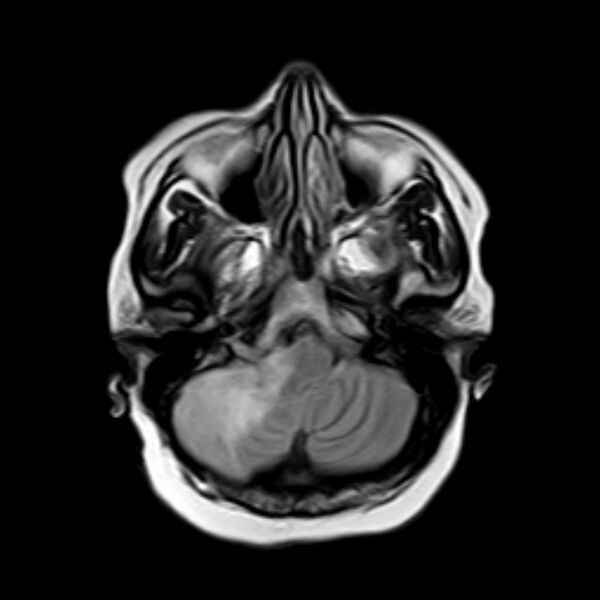 File:Neurofibromatosis type 2 (Radiopaedia 67470-76871 Axial FLAIR 4).jpg