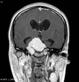 Neurofibromatosis type 2 - cranial and spinal involvement (Radiopaedia 5351-7111 Coronal T1 C+ 5).jpg