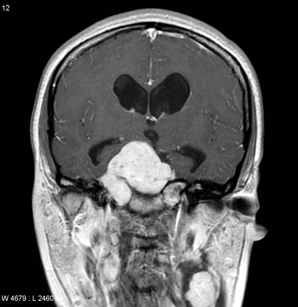 File:Neurofibromatosis type 2 - cranial and spinal involvement (Radiopaedia 5351-7111 Coronal T1 C+ 5).jpg