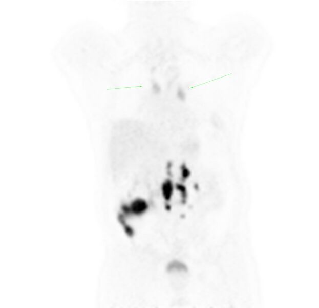 File:Non-Hodgkin lymphoma involving seminal vesicles with development of interstitial pneumonitis during Rituximab therapy (Radiopaedia 32703-33677 Annotated PET 3).jpg
