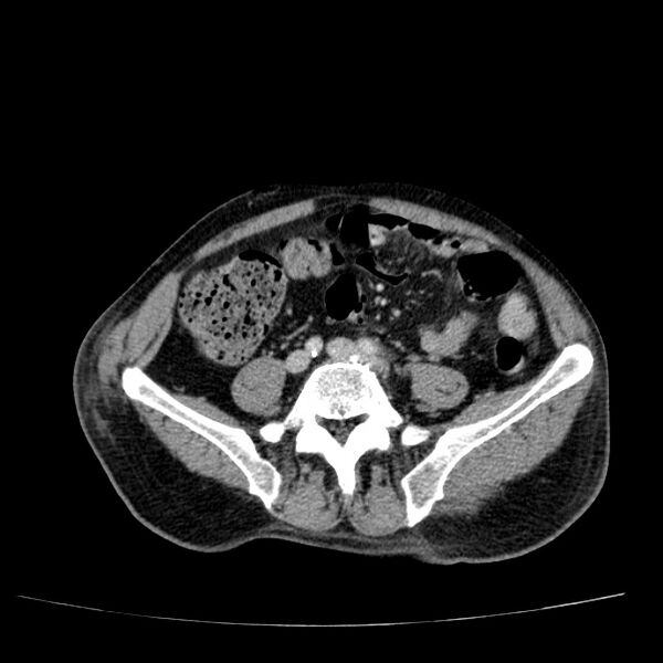 File:Non small-cell lung cancer (Radiopaedia 24467-24769 C+ delayed 92).jpg