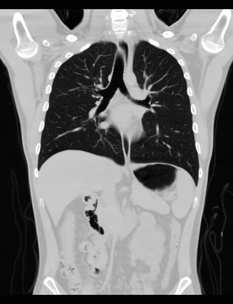 File:Normal CT virtual gastroscopy (Radiopaedia 29960-30501 F 5).jpg