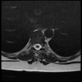 Normal cervical and thoracic spine MRI (Radiopaedia 35630-37156 H 21).png
