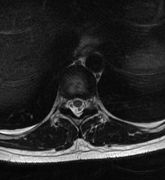 File:Normal thoracic spine MRI (Radiopaedia 41033-43781 Axial T2 13).jpg